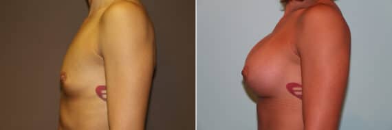 Before and after Breast Augmentation by Dr. Shervin Naderi, Patient 11275