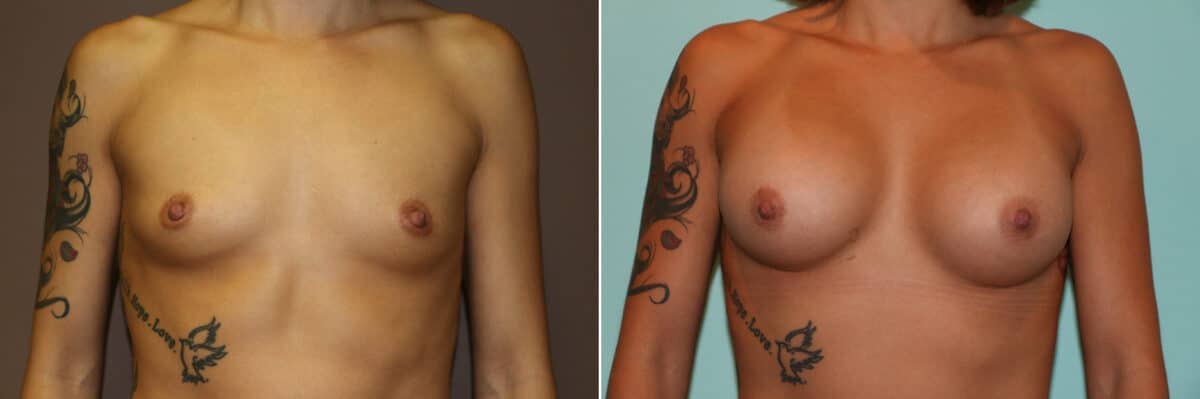 Patient 11275, Breast Augmentation Before and After Photos Before and after Breast Augmentation by Dr. Shervin Naderi, Patient 11275