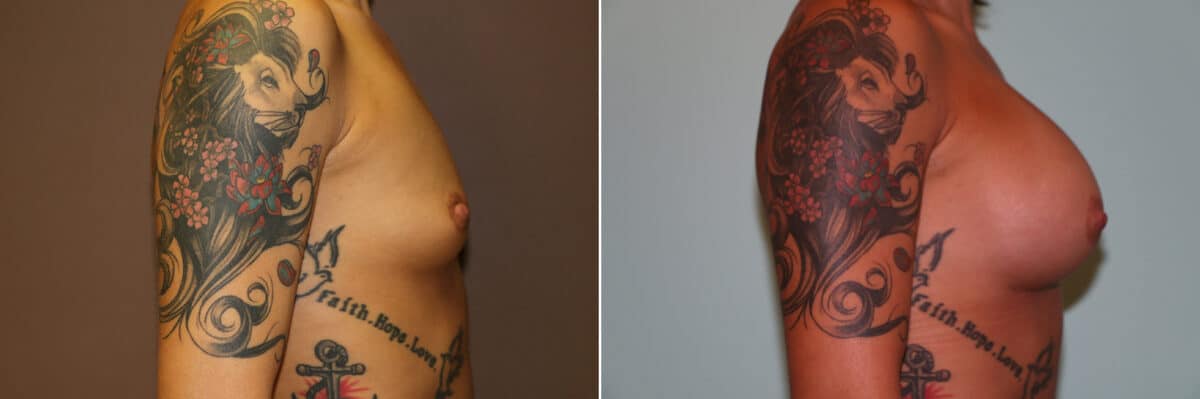 Patient 11275, Breast Augmentation Before and After Photos Before and after Breast Augmentation by Dr. Shervin Naderi, Patient 11275