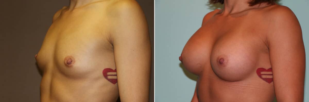 Patient 11275, Breast Augmentation Before and After Photos Before and after Breast Augmentation by Dr. Shervin Naderi, Patient 11275