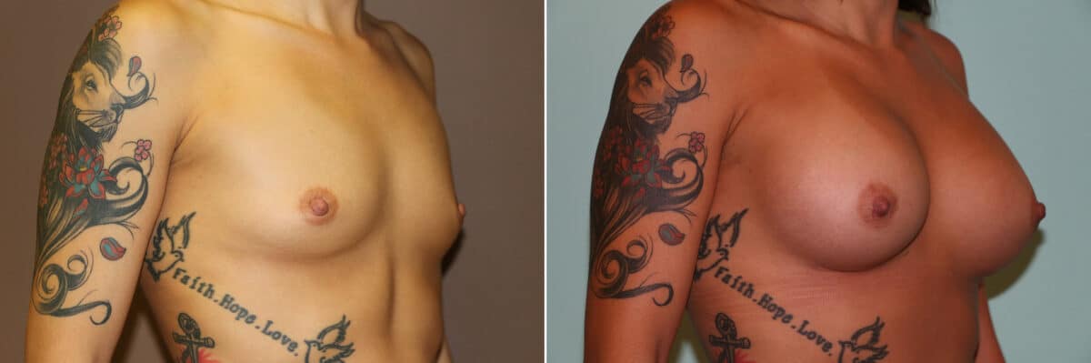 Patient 11275, Breast Augmentation Before and After Photos Before and after Breast Augmentation by Dr. Shervin Naderi, Patient 11275
