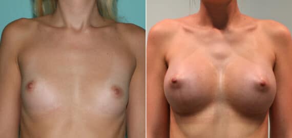 Before and after Breast Augmentation by Dr. Shervin Naderi, Patient 11968