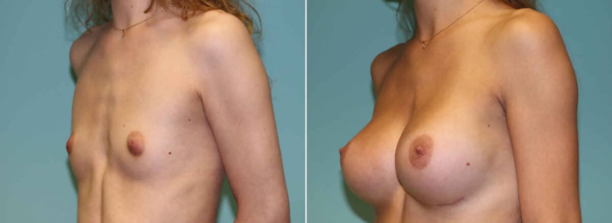 Patient 12875, Breast Augmentation Before and After Photos Before and after Breast Augmentation by Dr. Shervin Naderi, Patient 12875