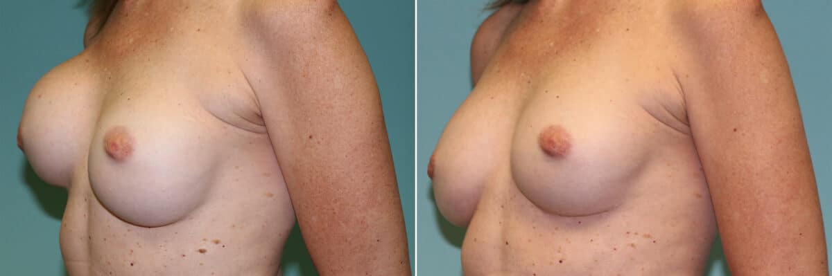 Patient 14341, Breast Augmentation Revision Before and After Photos Before and after Breast Augmentation Revision by Dr. Shervin Naderi, Patient 14341