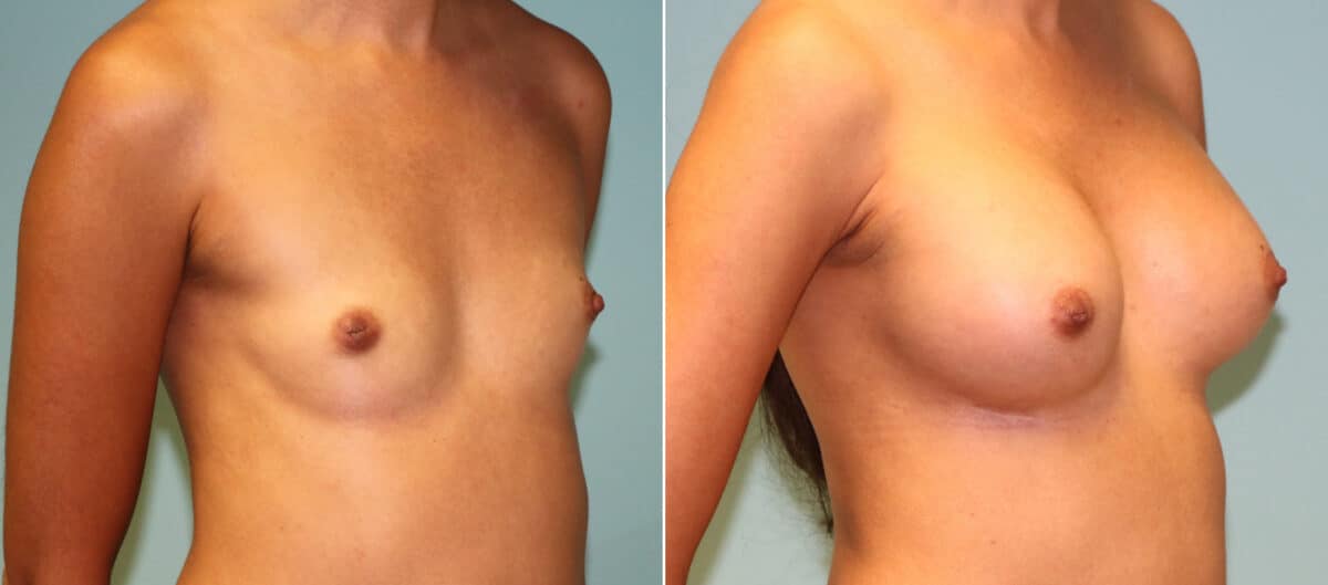 Patient 14374, Breast Augmentation Before and After Photos Before and after Breast Augmentation by Dr. Shervin Naderi, Patient 14374