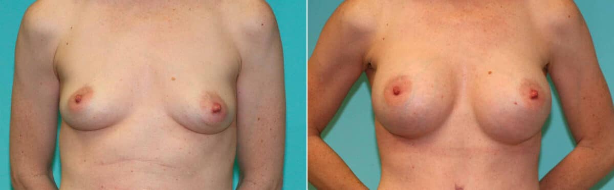 Patient 15535, Breast Augmentation Before and After Photos Before and after Breast Augmentation by Dr. Shervin Naderi, Patient 15535