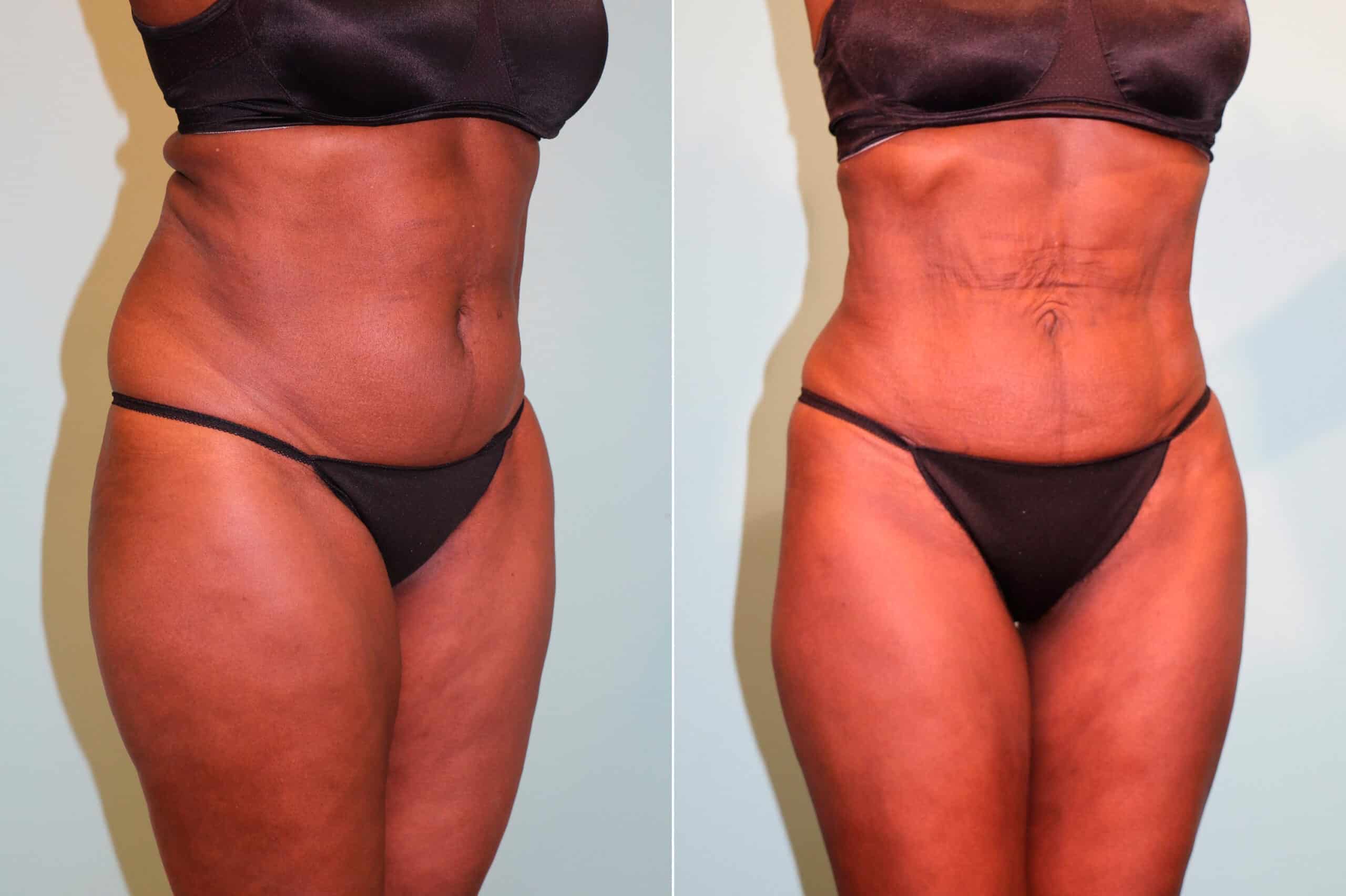 patient-15969-liposuction-before-after