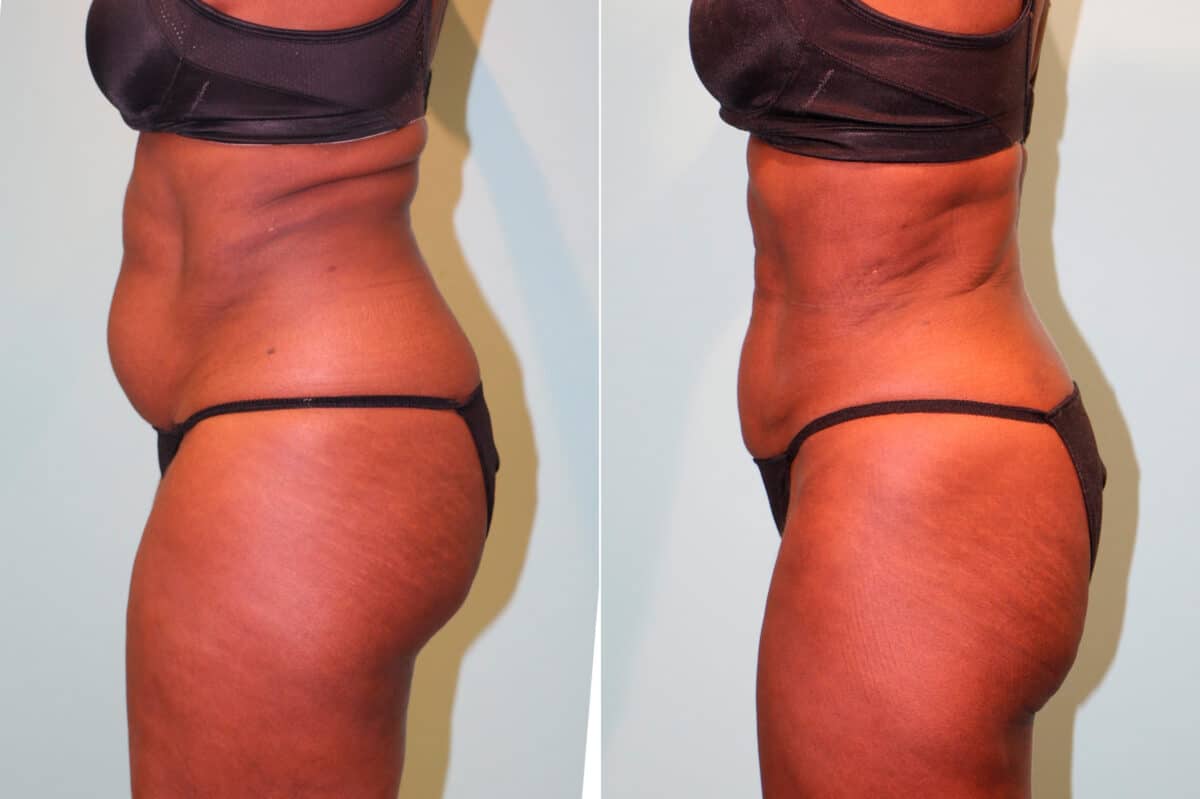 Patient 15969, Liposuction Before and After Photos Before and after Liposuction by Dr. Shervin Naderi, Patient 15969