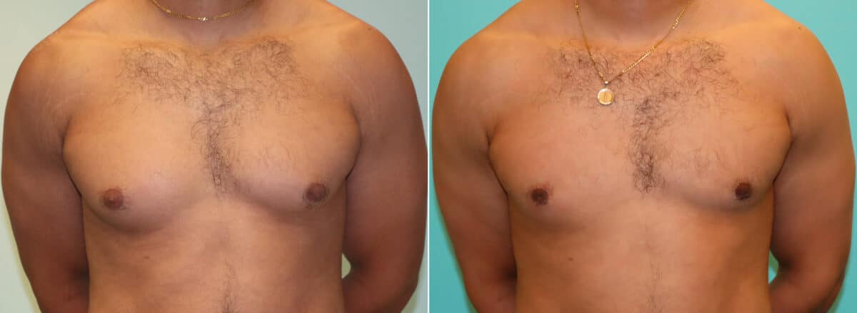 Patient 16461, Gynecomastia Before and After Photos Before and after Gynecomastia by Dr. Shervin Naderi, Patient 16461