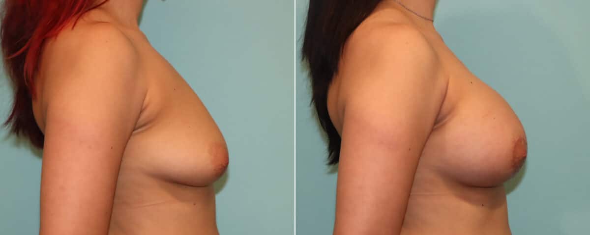 Patient 21710, Breast Augmentation Before and After Photos Before and after Breast Augmentation by Dr. Shervin Naderi, Patient 21710