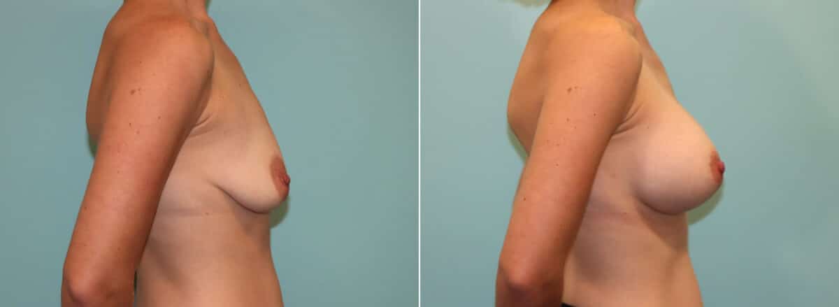 Patient 23514, Breast Augmentation Before and After Photos Before and after Breast Augmentation by Dr. Shervin Naderi, Patient 23514