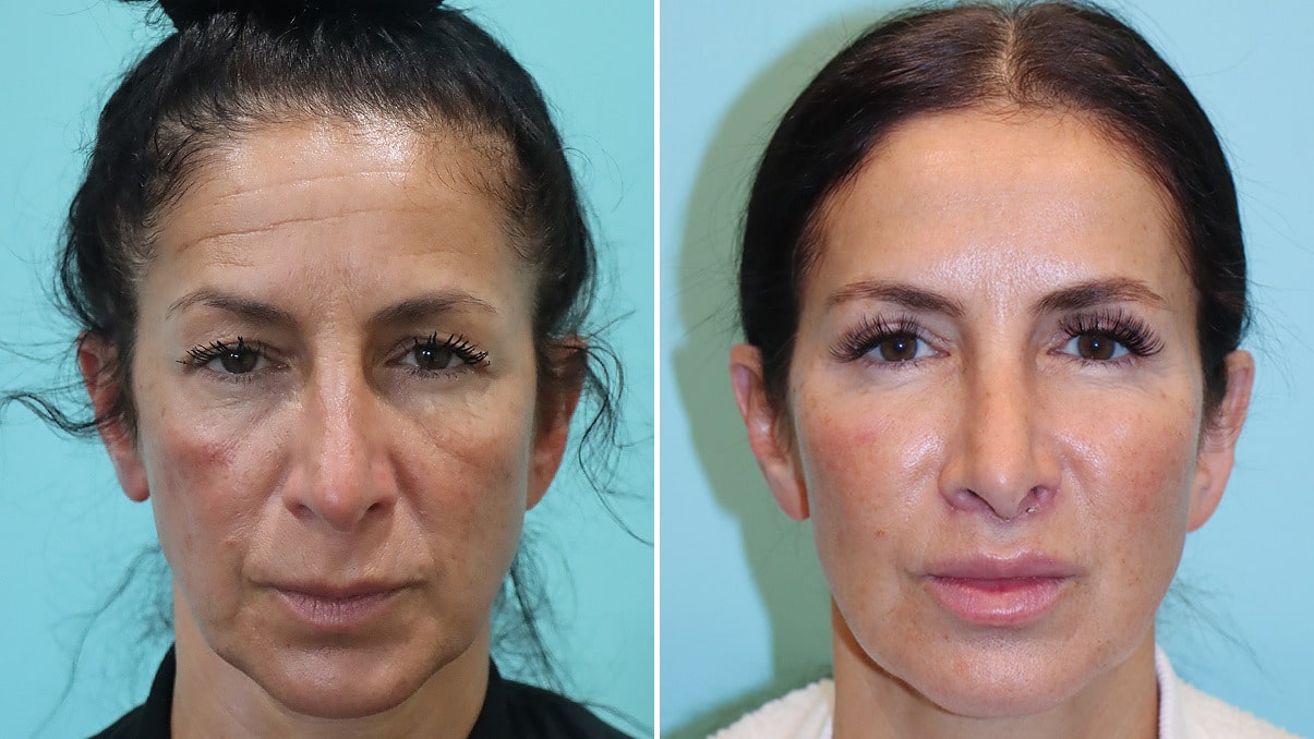 botox before and after forehead lines treatment