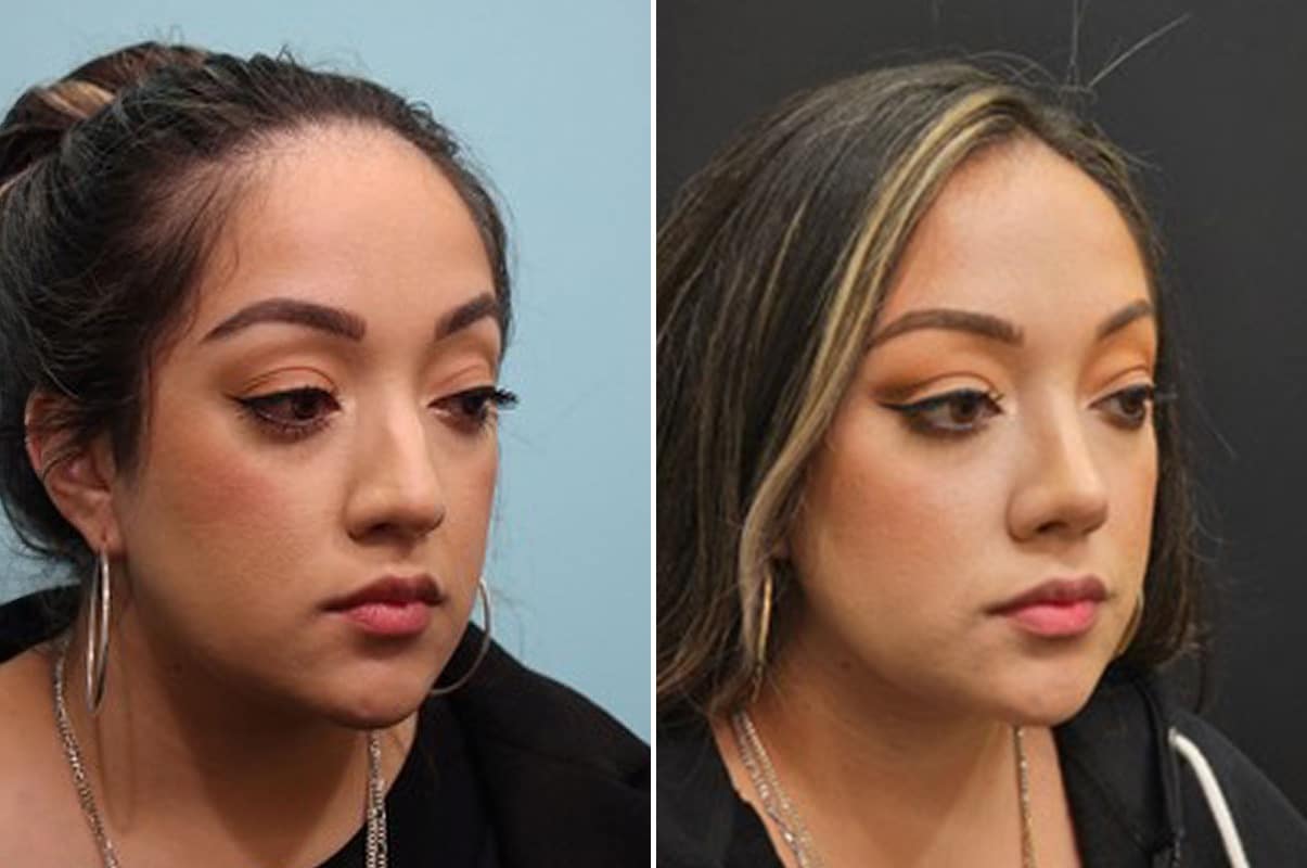 patient-28146-rhinoplasty-before-after