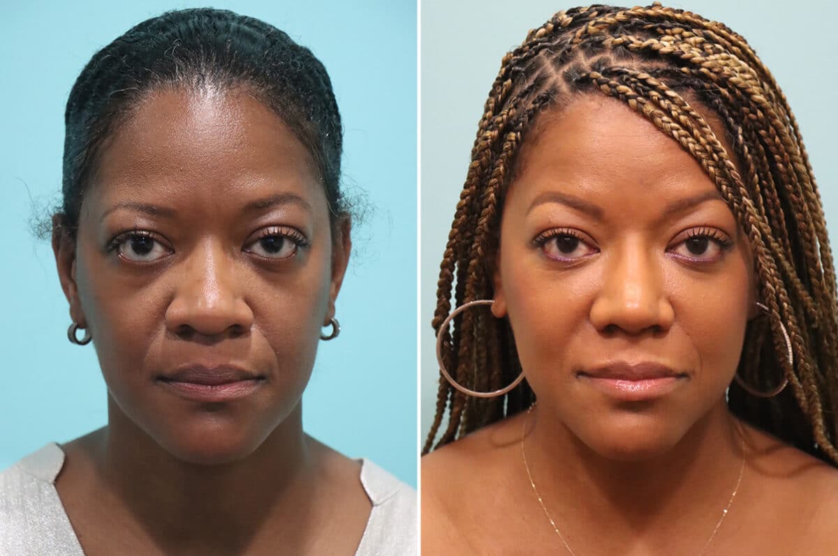 Patient 28191, Rhinoplasty Before and After Photos Before and after Rhinoplasty by Dr. Shervin Naderi, Patient 28191