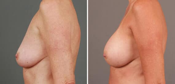 Before and after Breast Augmentation by Dr. Shervin Naderi, Patient 9375