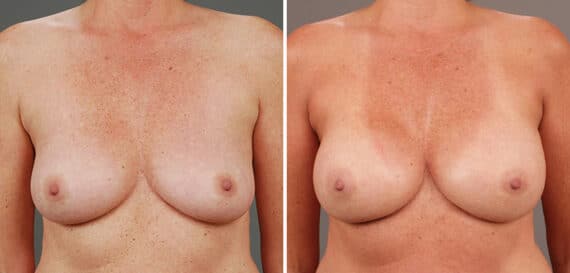 Before and after Breast Augmentation by Dr. Shervin Naderi, Patient 9375