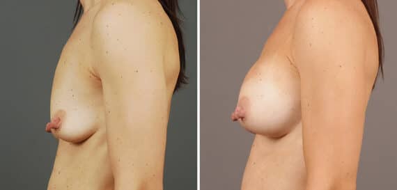 Before and after Breast Augmentation by Dr. Shervin Naderi, Patient 9392