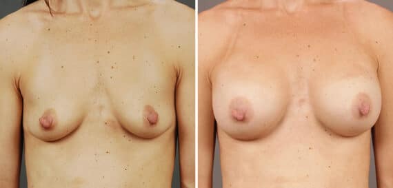 Before and after Breast Augmentation by Dr. Shervin Naderi, Patient 9392