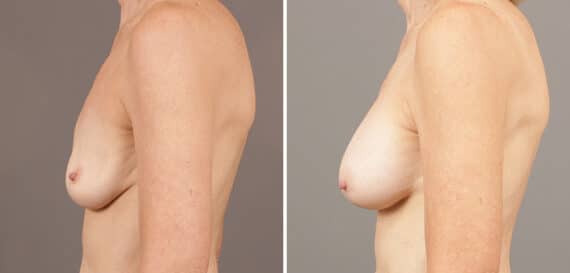 Before and after Breast Augmentation by Dr. Shervin Naderi, Patient 9502