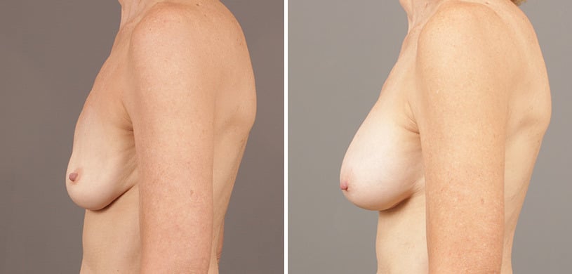 Patient 9502, Breast Augmentation Before and After Photos Before and after Breast Augmentation by Dr. Shervin Naderi, Patient 9502