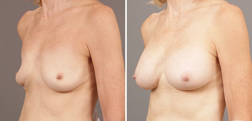 Patient 9502, Breast Augmentation Before and After Photos Before and after Breast Augmentation by Dr. Shervin Naderi, Patient 9502