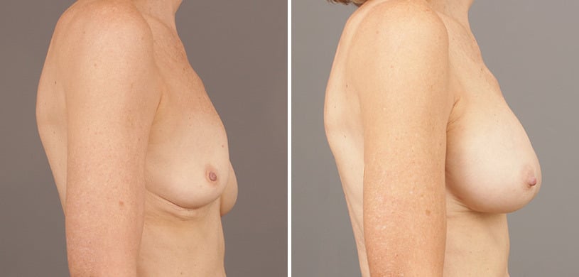 Patient 9502, Breast Augmentation Before and After Photos Before and after Breast Augmentation by Dr. Shervin Naderi, Patient 9502
