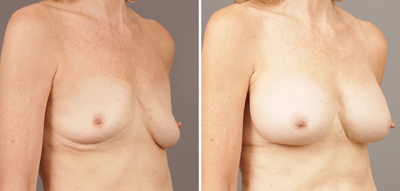 Patient 9502, Breast Augmentation Before and After Photos Before and after Breast Augmentation by Dr. Shervin Naderi, Patient 9502