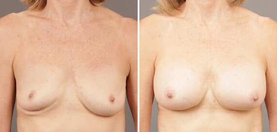 Before and after Breast Augmentation by Dr. Shervin Naderi, Patient 9502