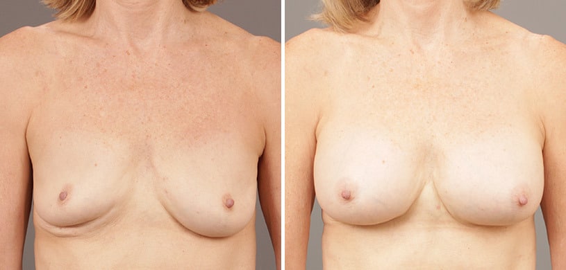Patient 9502, Breast Augmentation Before and After Photos Before and after Breast Augmentation by Dr. Shervin Naderi, Patient 9502