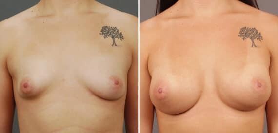 Before and after Breast Augmentation by Dr. Shervin Naderi, Patient 9510
