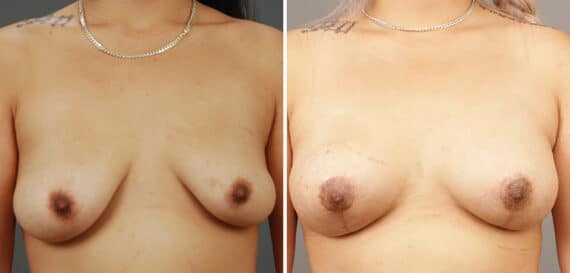 Before and after Breast Augmentation by Dr. Shervin Naderi, Patient 9521