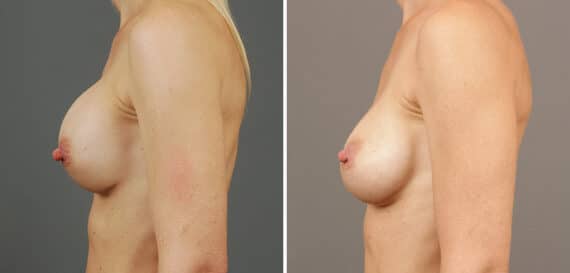 Before and after Breast Augmentation by Dr. Shervin Naderi, Patient 9551
