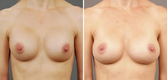 Before and after Breast Augmentation by Dr. Shervin Naderi, Patient 9551