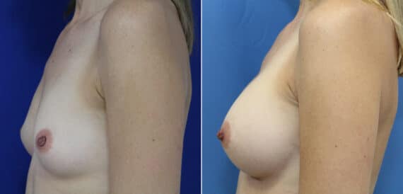 Before and after Breast Augmentation by Dr. Shervin Naderi, Patient 9837