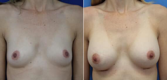 Before and after Breast Augmentation by Dr. Shervin Naderi, Patient 9837