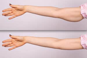 A before and after comparison of a young woman who had a brachioplasty and arm liposuction.