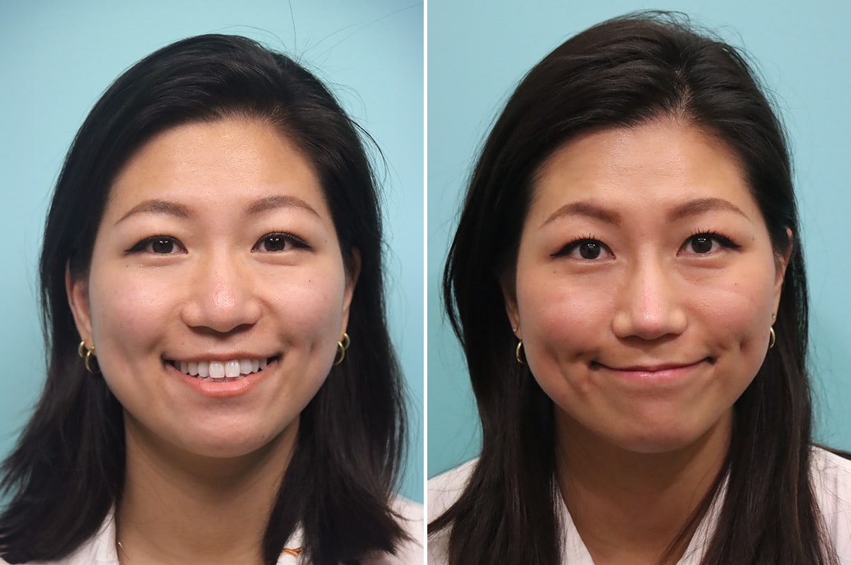patient-30042-rhinoplasty-before-after