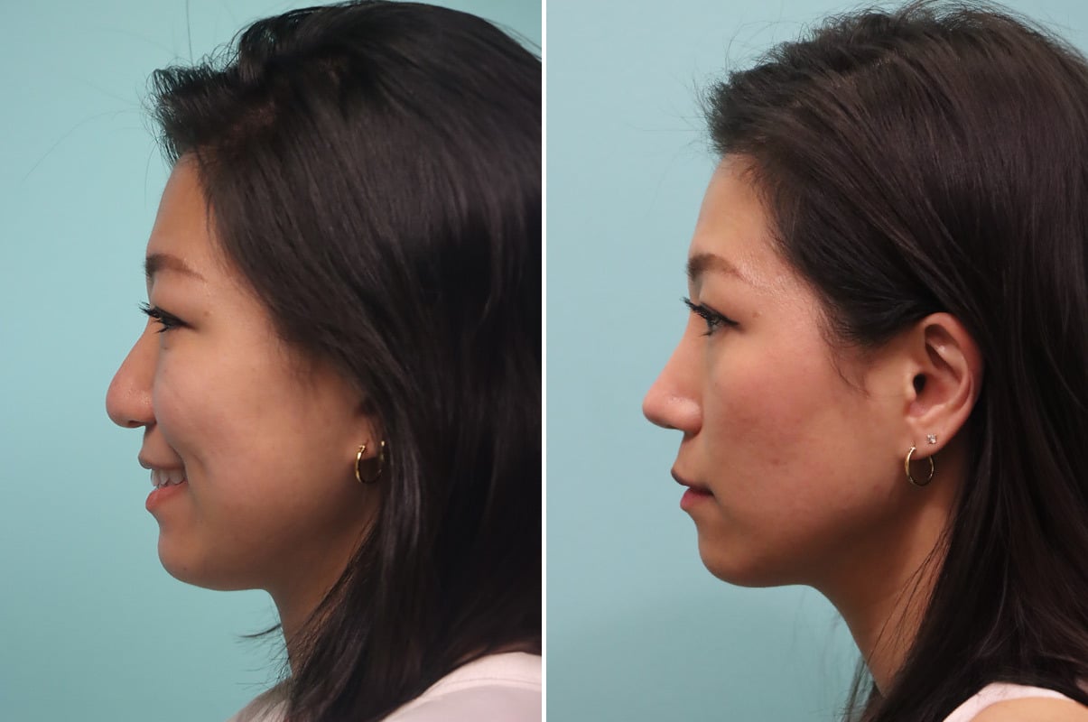 patient-30042-rhinoplasty-before-after