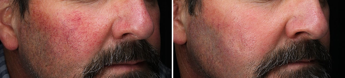 patient-30102-laser-treatments-before-after