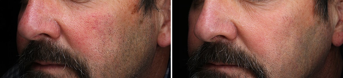 patient-30102-laser-treatments-before-after