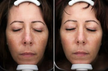 Before and after Light Therapy by Dr. Shervin Naderi, Patient 30146