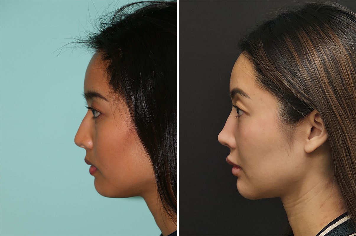 健康・医学 atlas of asian rhinoplasty Dr. Suh published his 5th book titled 'Atlas of Asian Rhinoplasty