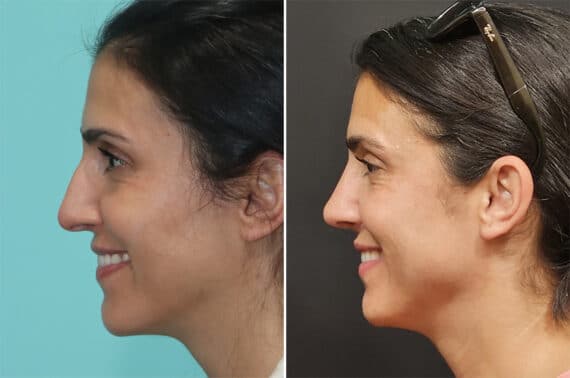 Before and after Rhinoplasty by Dr. Shervin Naderi, Patient 36843