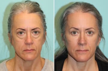 Before and after Blepharoplasty by Dr. Shervin Naderi, Patient 36944