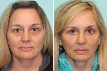 Blepharoplasty before and after at The Naderi Center, Reston, VA and Chevy Chase, MD, Patient 36949