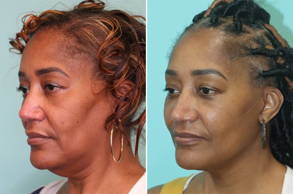 Facelift before and after photo showing the neck and jawline, three-quarter view, The Naderi Center