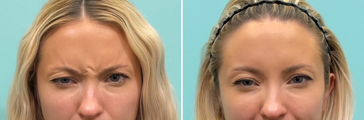botox before and after frown lines treatment