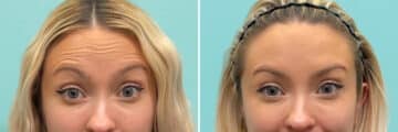 Before and after Botox Injections by Dr. Shervin Naderi, Patient 36984