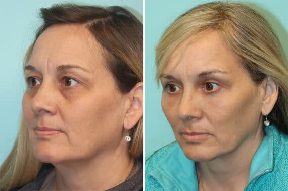 Before and after Fat Transfer by Dr. Shervin Naderi, Patient 37078
