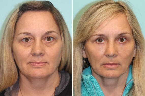 Before and after Fat Transfer by Dr. Shervin Naderi, Patient 37078